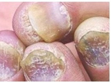 看图识病 灰指甲的症状有哪些
