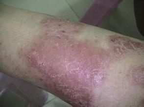 专门治疗牛皮癣的药膏