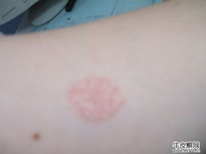 牛皮癣怎么治疗才能恢复的更快